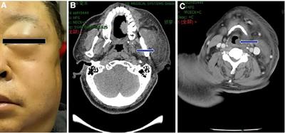 Anesthesia mumps with airway obstruction after radical nephrectomy: A case report and literature review